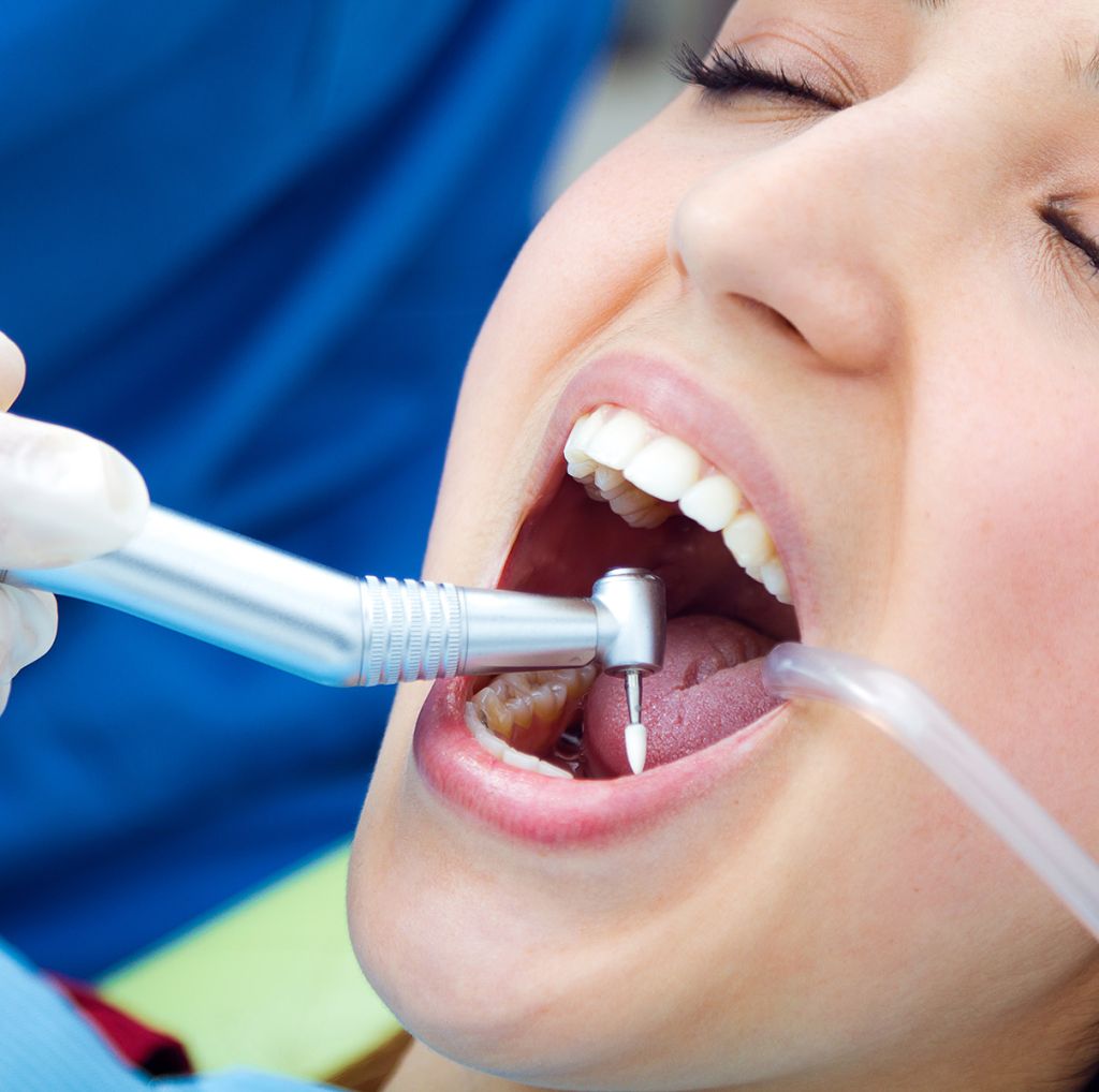 Fillings & Cavities - SoBro Dental - Broad Ripple / SoBro Dentistry - Indianapolis, Indiana