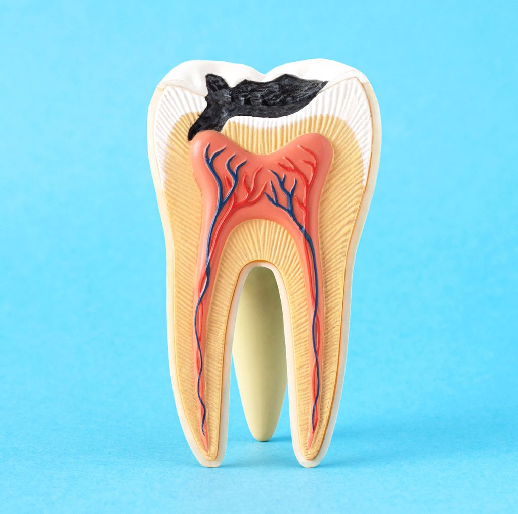 Fillings & Cavities - SoBro Dental - Broad Ripple / SoBro Dentistry - Indianapolis, Indiana