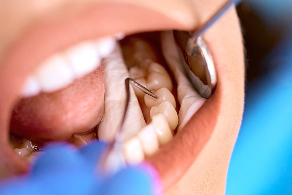 Fillings & Cavities - SoBro Dental - Broad Ripple / SoBro Dentistry - Indianapolis, Indiana