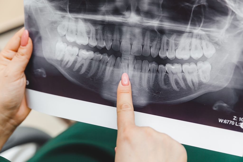 Digital X-Rays - SoBro Dental - Broad Ripple / SoBro Dentistry - Indianapolis, Indiana