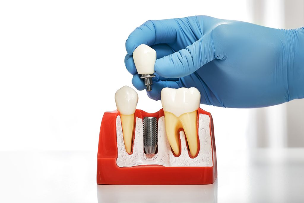 Dental Implants - SoBro Dental - Broad Ripple / SoBro Dentistry - Indianapolis, Indiana
