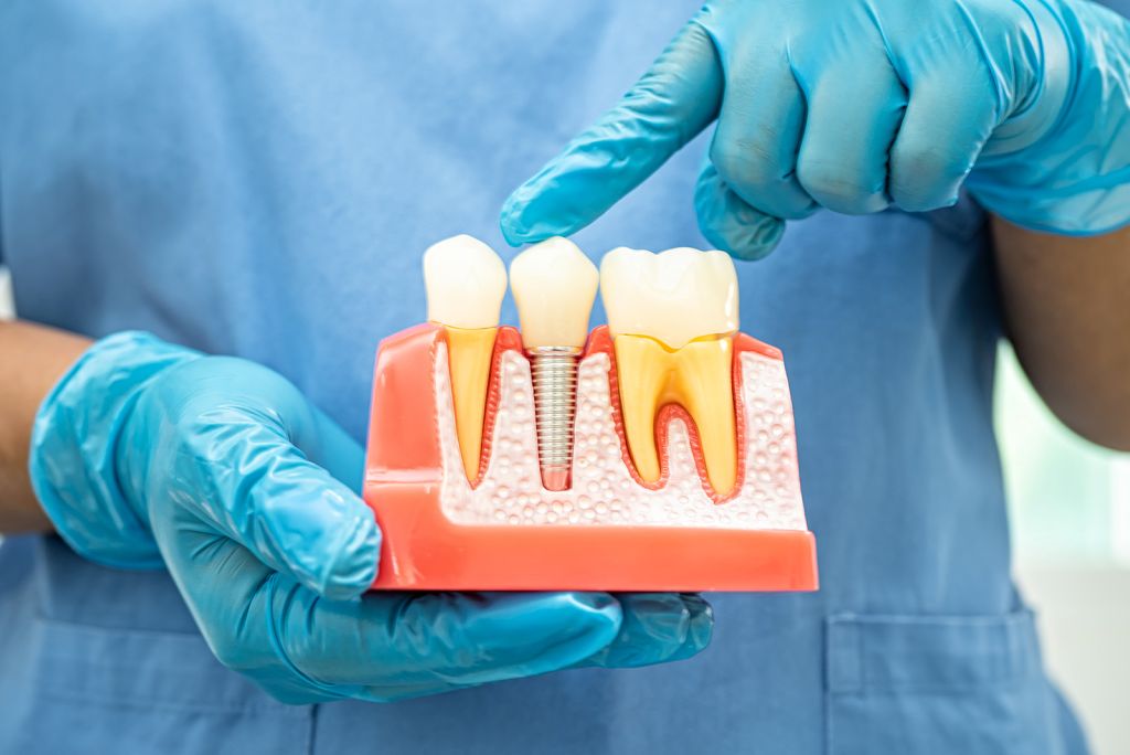 Dental Implants - SoBro Dental - Broad Ripple / SoBro Dentistry - Indianapolis, Indiana