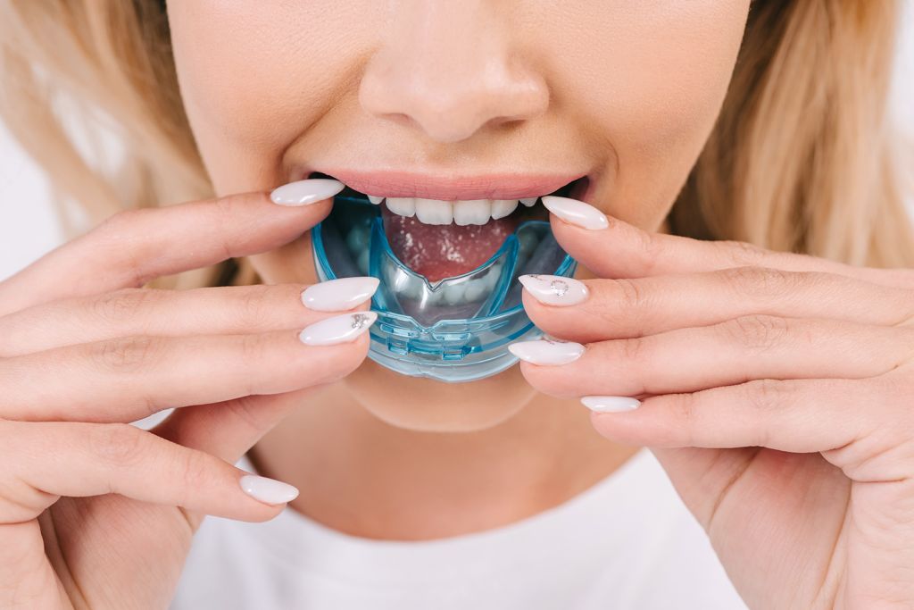 Mouthguards & Nightguards - SoBro Dental - Broad Ripple / SoBro Dentistry - Indianapolis, Indiana