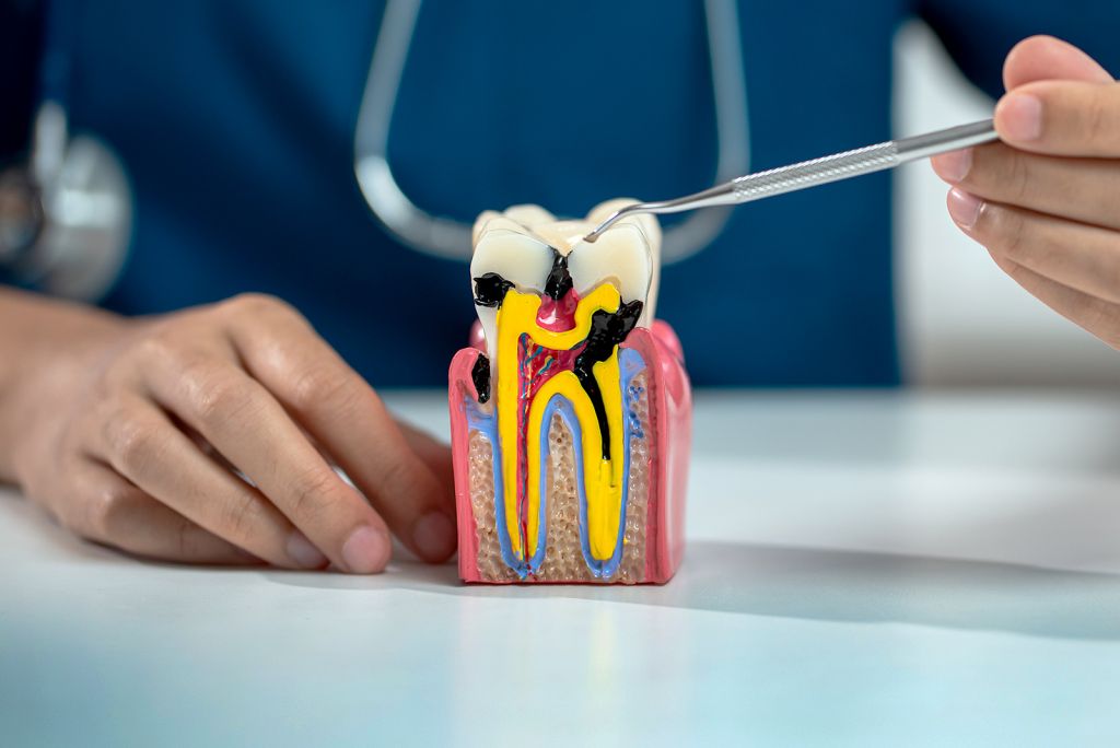 Dental Root Canal - SoBro Dental - Broad Ripple / SoBro Dentistry - Indianapolis, Indiana