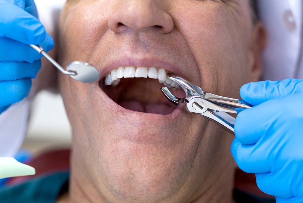 Tooth Extractions - SoBro Dental - Broad Ripple / SoBro Dentistry - Indianapolis, Indiana