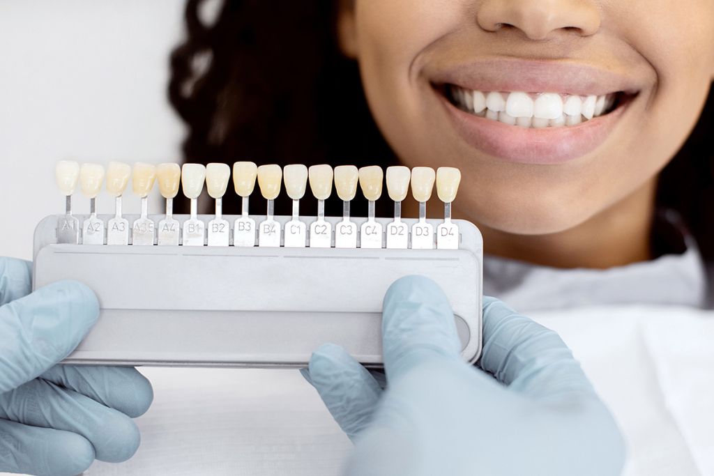 Dental Veneers - SoBro Dental - Broad Ripple / SoBro Dentistry - Indianapolis, Indiana