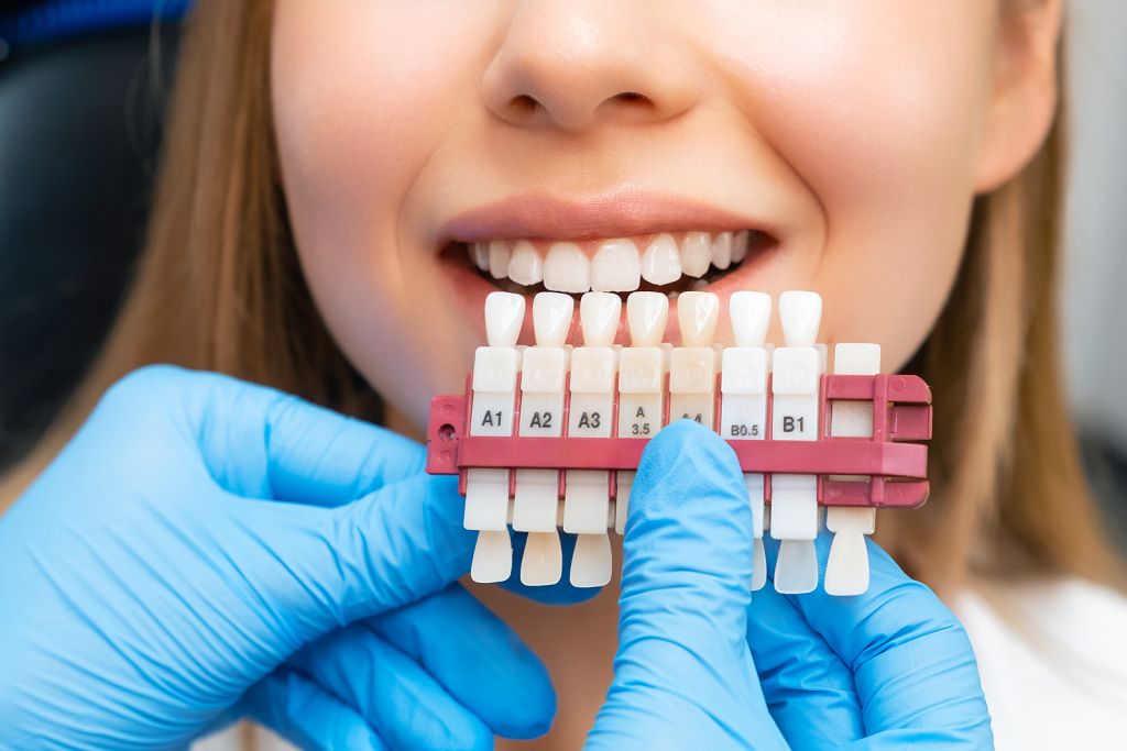 Dental Veneers - SoBro Dental - Broad Ripple / SoBro Dentistry - Indianapolis, Indiana