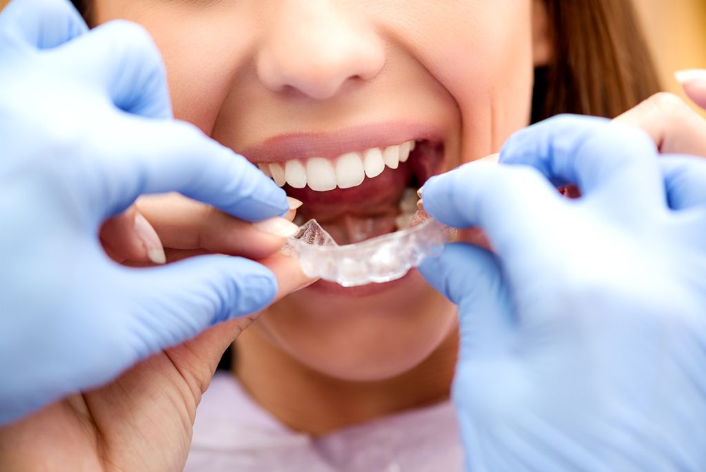 Invisalign Treatment Invisible Braces - SoBro Dental - Broad Ripple / SoBro Dentistry - Indianapolis, Indiana